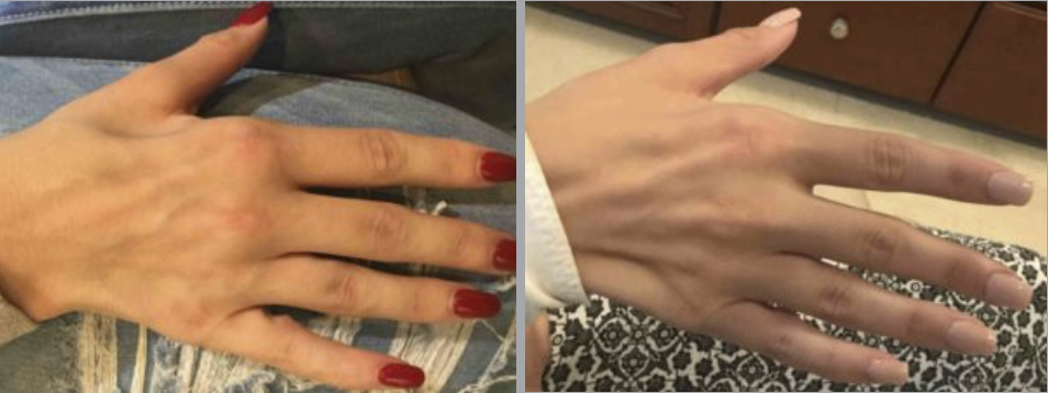 Restylane® Lyft in Ventura, CA